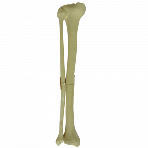 TÍBIA ESQUERDA COM FÍBULA - FRATURA 1 - cód. 9700