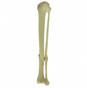 TÍBIA ESQUERDA COM FÍBULA - FRATURA 2 - cód. 9701